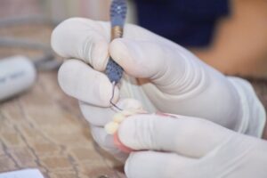 入れ歯を修理している様子