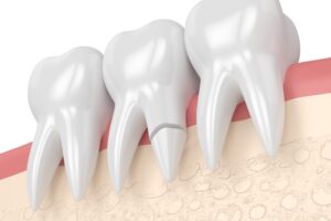 歯根破折をしている画像