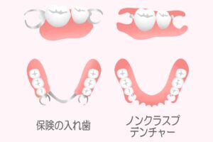 保険の入れ歯とノンクラスプデンチャーの違い