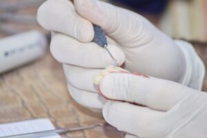 入れ歯を修理している様子